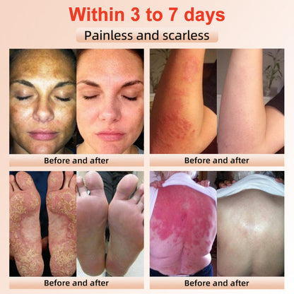 Purifying Exfoliating Gel for Acanthosis Nigricans, Exfoliation, Dark Spots, Skin Tags, Eczema